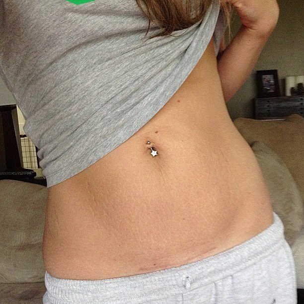 Yes, non-Photoshopped bodies have scars and stretch marks. Instagram user ambidawnz wrote: "Lets be real, this is my body, these are my scars, why should I hide? I can still be fit and I can still feel beautiful. Real woman right here, no fakeness. I am proud of what my body has done, grew two amazing healthy smart witty handsome sons in there. "
Yes, non-Photoshopped bodies have scars and stretch marks. Instagram user ambidawnz wrote: "Lets be real, this is my body, these are my scars, why should I hide? I can still be fit and I can still feel beautiful. Real woman right here, no fakeness. I am proud of what my body has done, grew two amazing healthy smart witty handsome sons in there. "