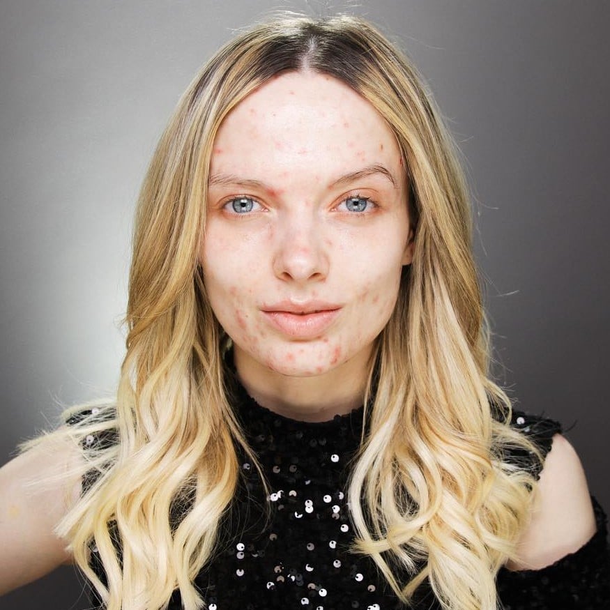 How to feel pretty with acne