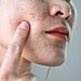 How to Treat Broken Capillaries on the Face