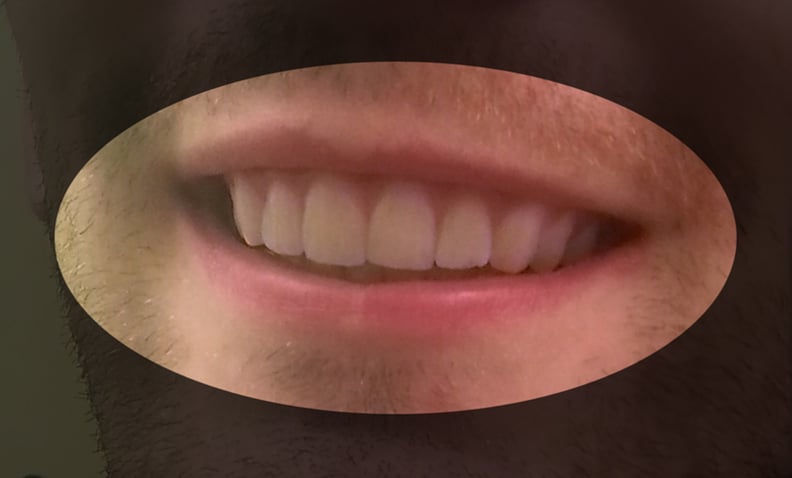 Amos's Teeth After
