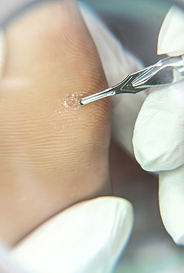 Wart Treatments and Types, According to Doctors