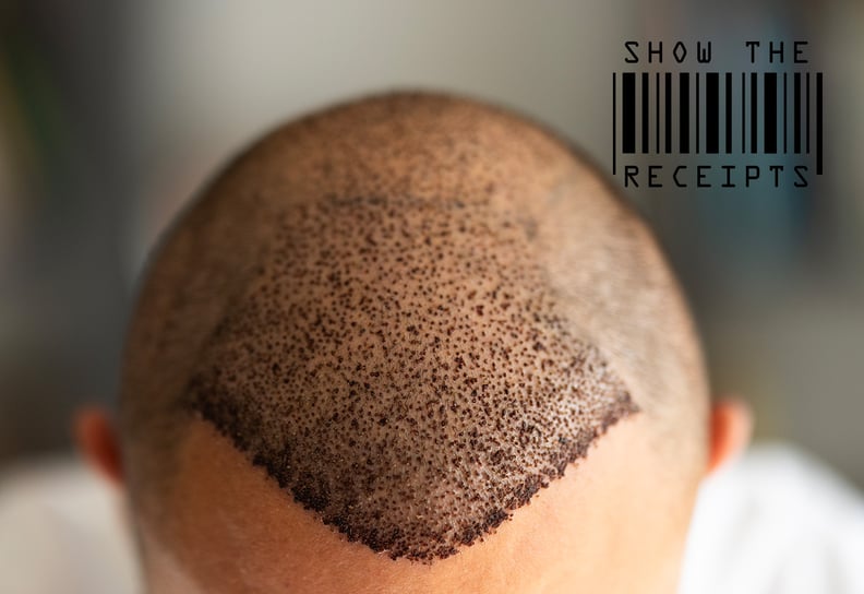 He Spent $10,864 on a Hair Transplant — and Considered That a Good Deal
