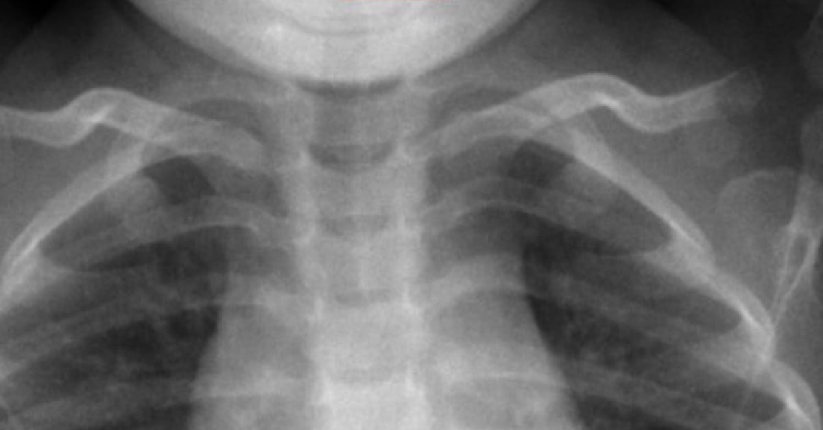 How Dangerous Are Button Batteries? POPSUGAR Family