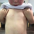 This Mom Is Warning Parents About a Tick-Borne Illness After Her Son Came Home With a Bizarre Rash
