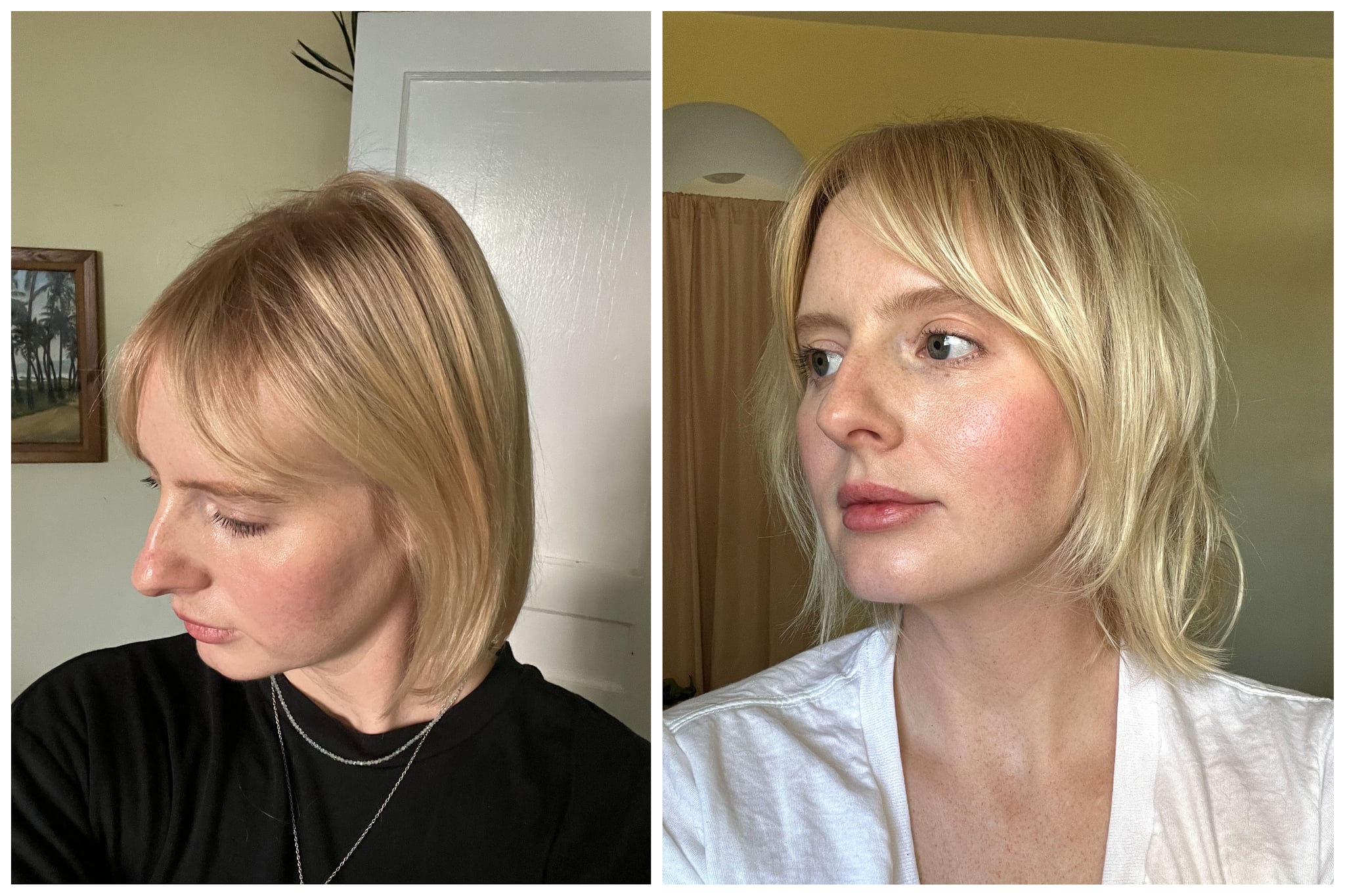 I Got PRP Injections For Hair Loss: See Photos | POPSUGAR Beauty