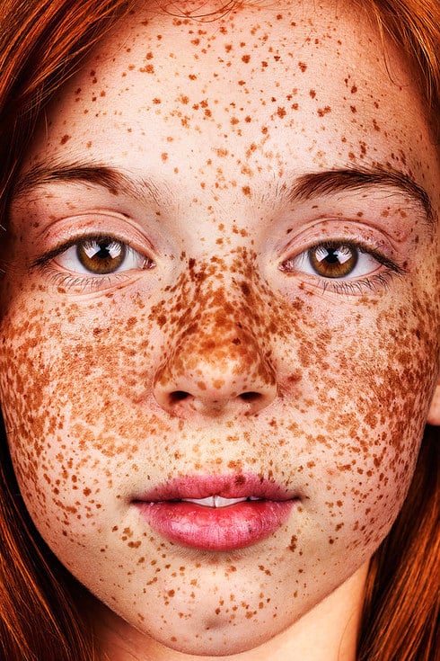 lots of freckles
