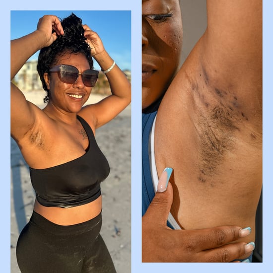 How I Learned to Accept My Hidradenitis Suppurativa