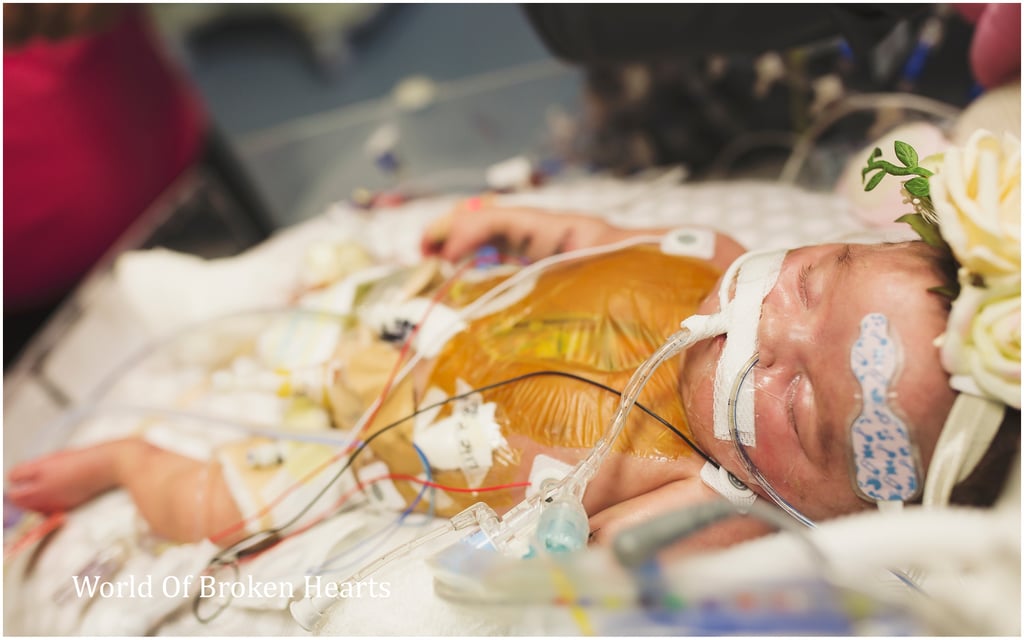 Twin With Heart Defect