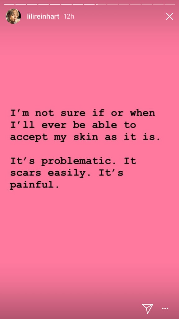 Lili Reinhart Posts About Cystic Acne on Instagram Stories