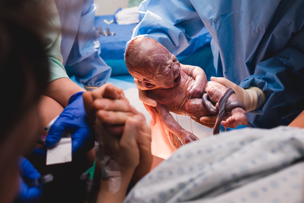 Premature Delivery Birth Photos