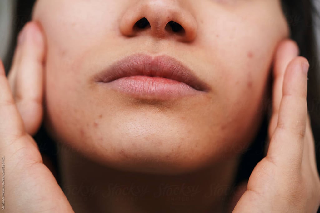 How to Remove Blackheads At Home, According to a Facialist