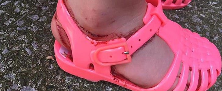 Jelly Sandals Left Girl's Feet Bleeding and Bruised