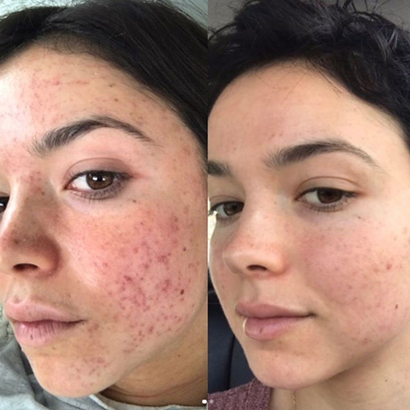 Bekah Martinez Shares Her Acne Journey On Instagram Popsugar Beauty