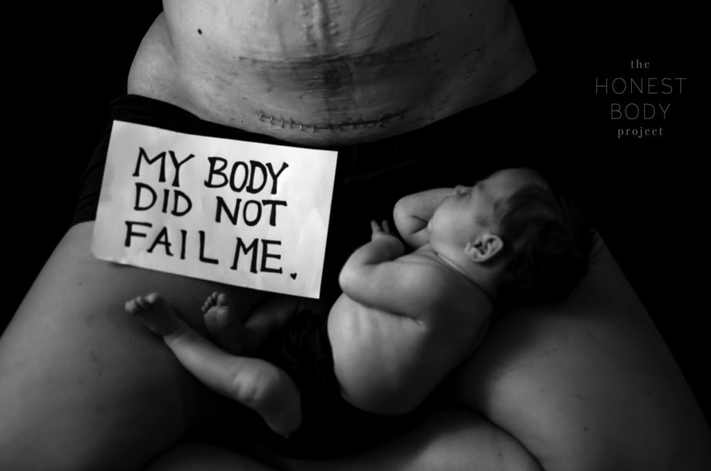 Honest Body Project Stapled C-Section Scar Photo Shoot