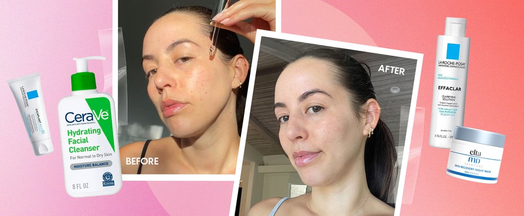 I Tried Skin Cycling on Acne-Prone Skin: See Photos