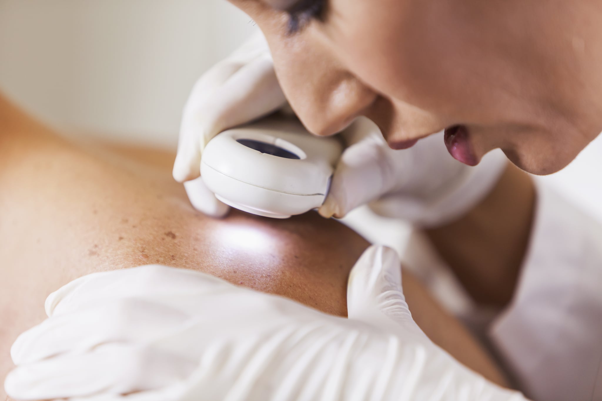 what is melanoma, what does melanoma look like, what does melanoma skin cancer look like, how long can you have melanoma and not know it, Melanoma symptoms, is melanoma curable, is melanoma deadly, what causes melanoma