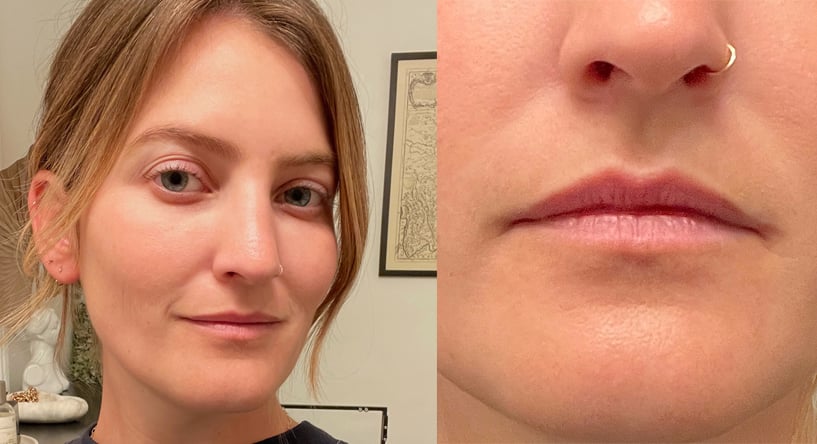 I Tried Cheek Filler: See and After Photos | POPSUGAR Beauty