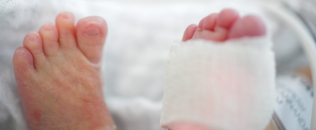 How to Get Rid of Hair Tourniquets From Baby Toes