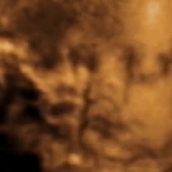 Guardian Angel Appears in Ultrasound