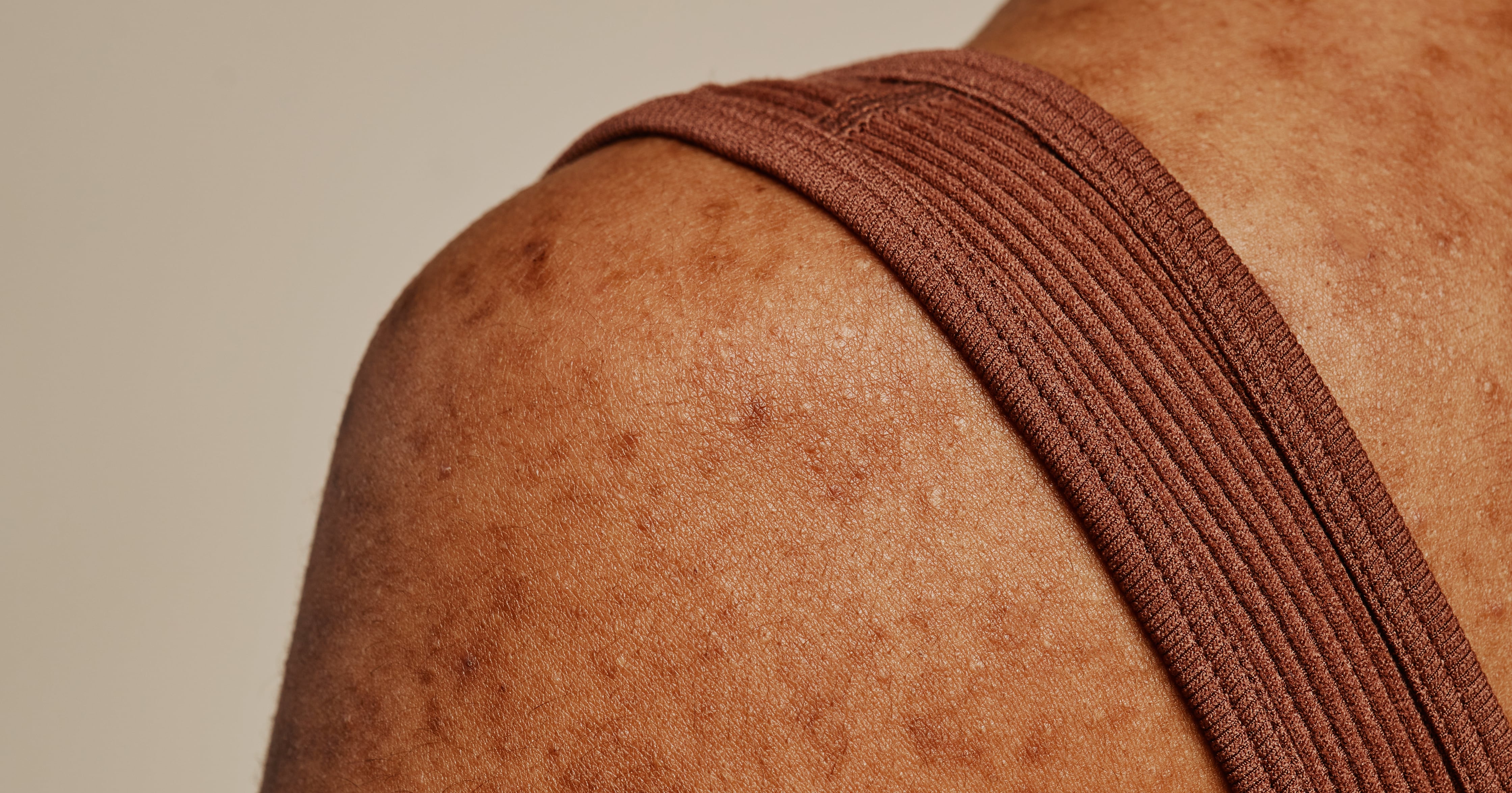 Hidradenitis Suppurativa on Black Skin: Causes and Effects