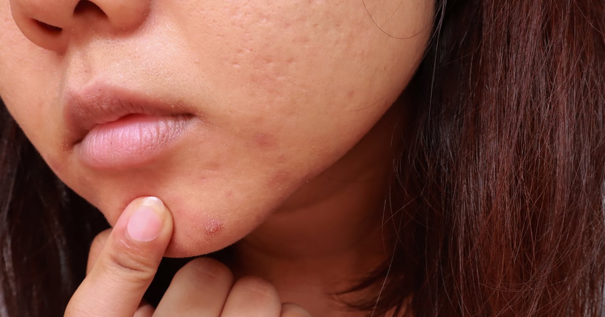 Everything You Need to Know About Treating Cystic Acne, According to Dermatologists