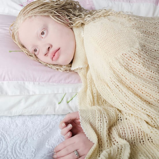 Albinism Photographs