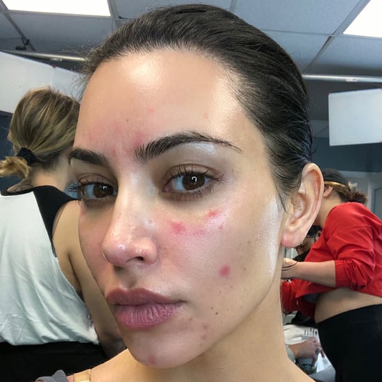 Kim Kardashian Talks About Her Psoriasis With Photos