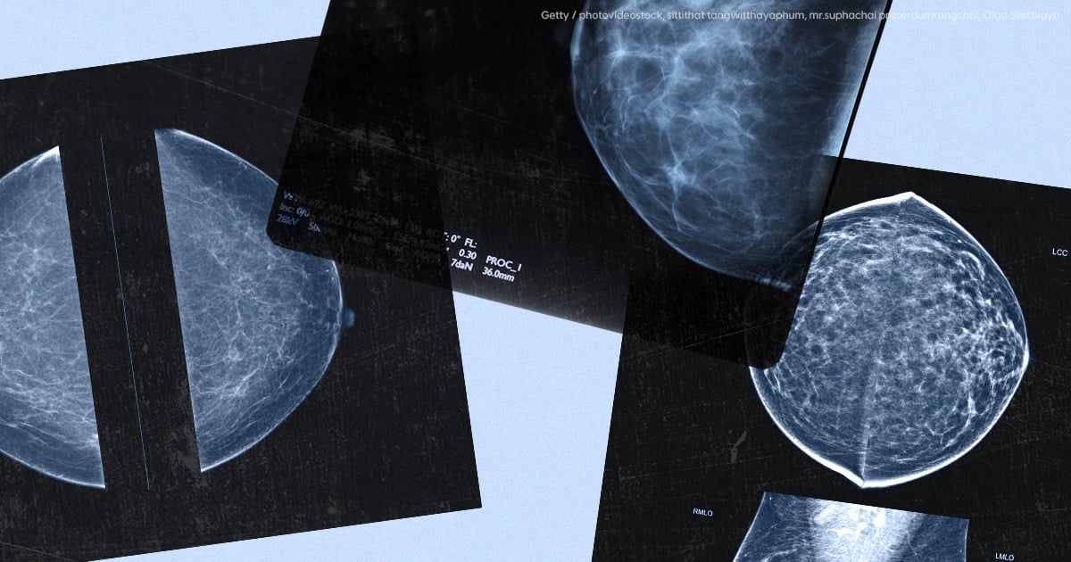 Could AI Help Catch Breast Cancers That Mammograms Miss?