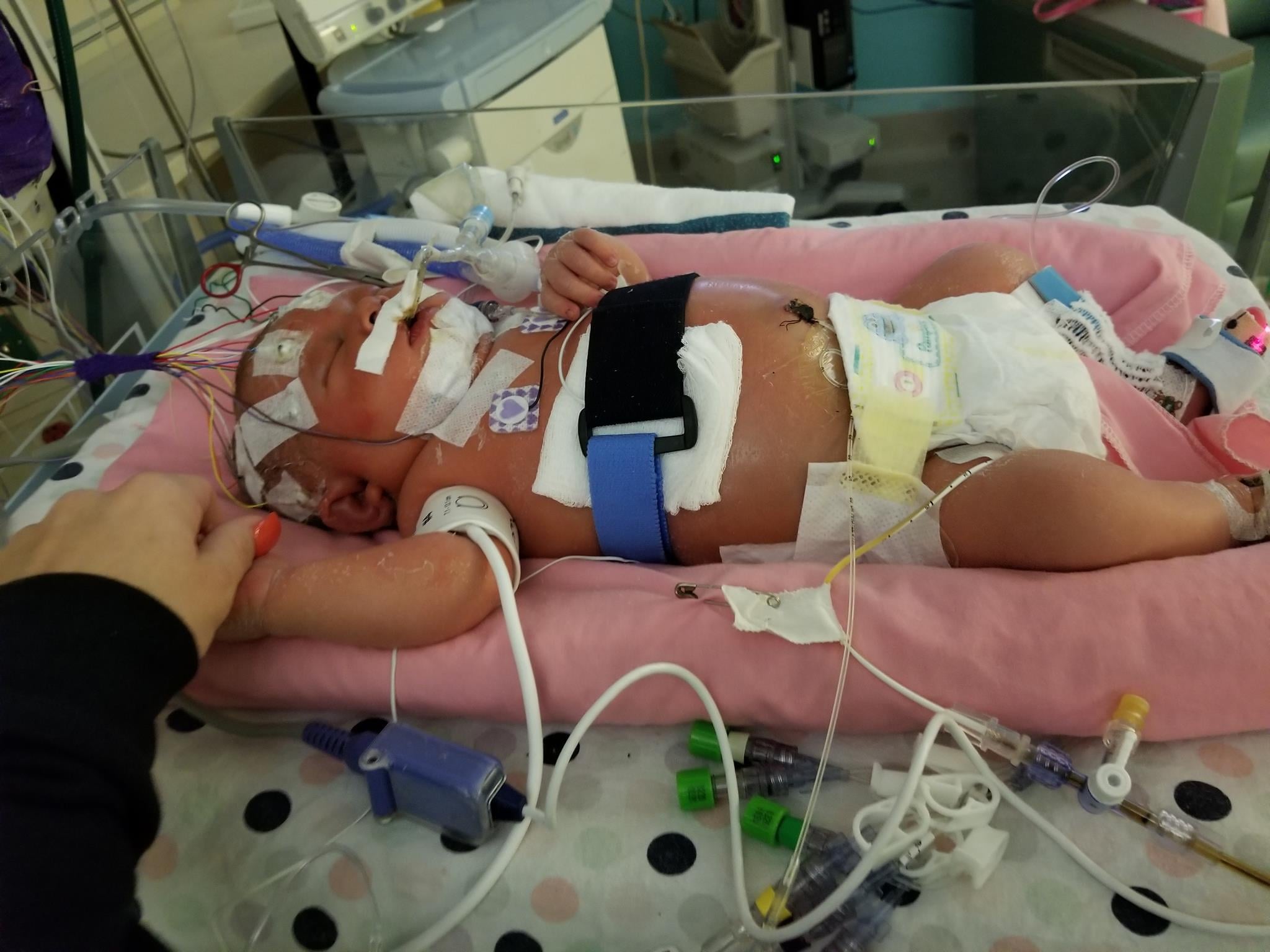 Newborn Baby Dies From Meningitis HSV1 POPSUGAR Moms