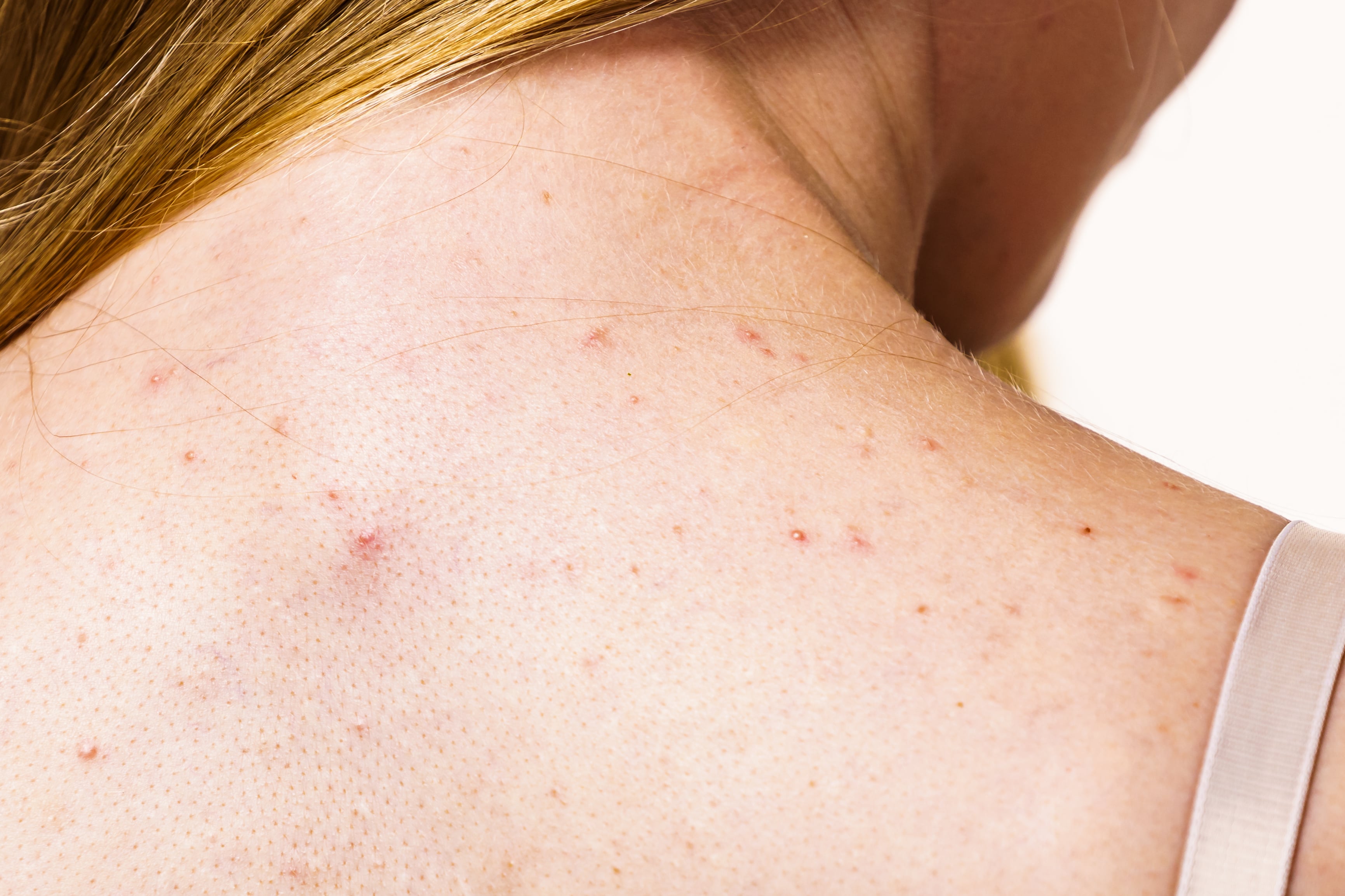 How to Get Rid of Back Acne: A Dermatologist Explains | PS Beauty