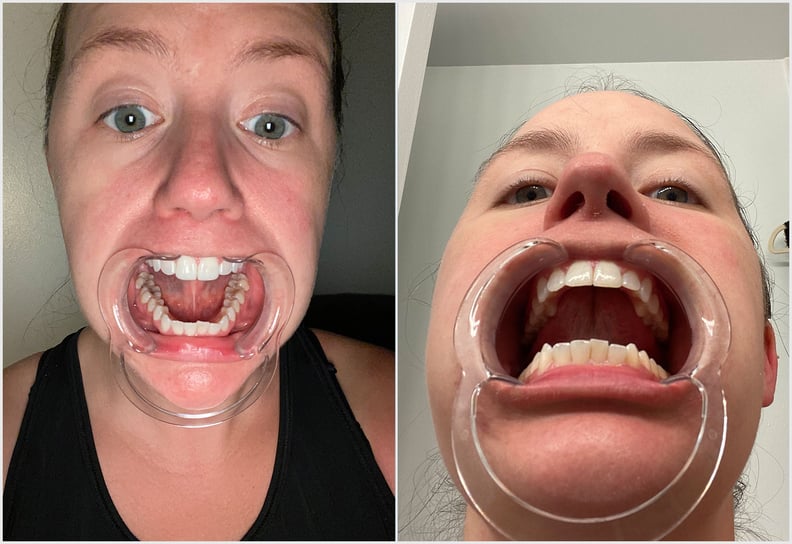 Smile Direct Club Teeth Aligners Review and Photos POPSUGAR Beauty