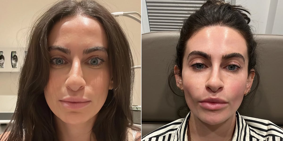I Tried the "Lip Tenting" Filler Technique: See Photos - Vimarsana News