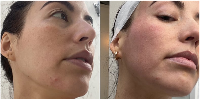 cryo facial acne before and after 
