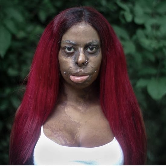 A Woman Is Reclaiming Her Burn Scars With Tattoos: Essay