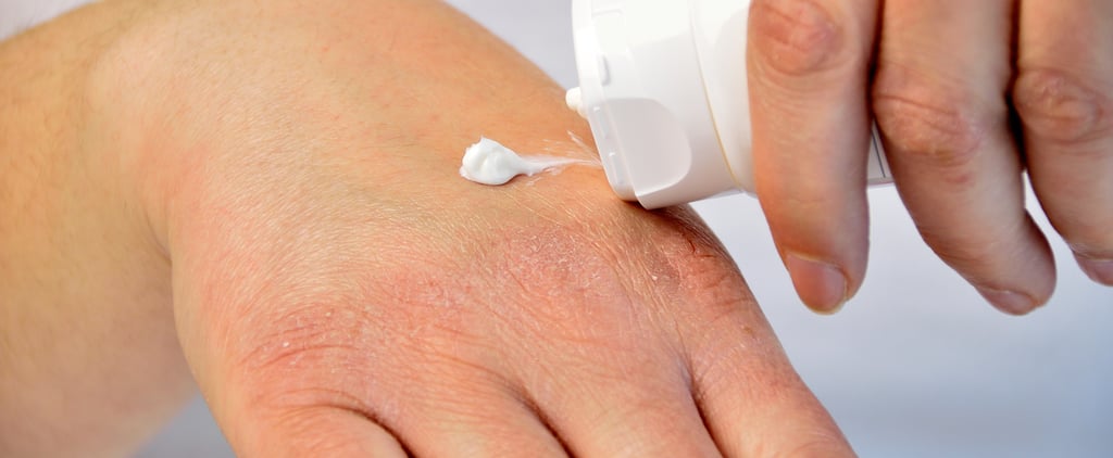 How to Treat and Prevent Eczema Flare Ups