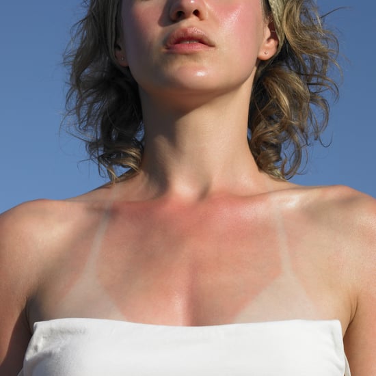 How to Treat and Heal Sunburn Fast