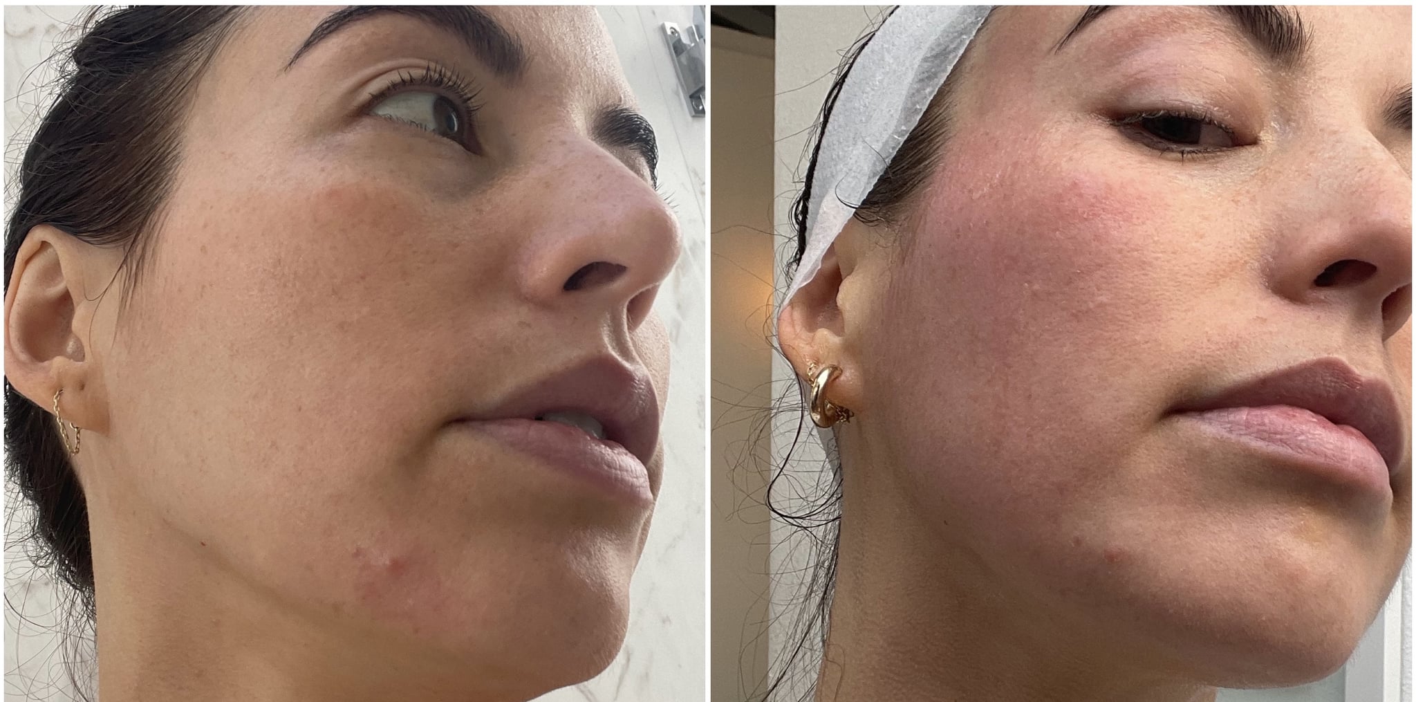 cryo facial acne before and after 