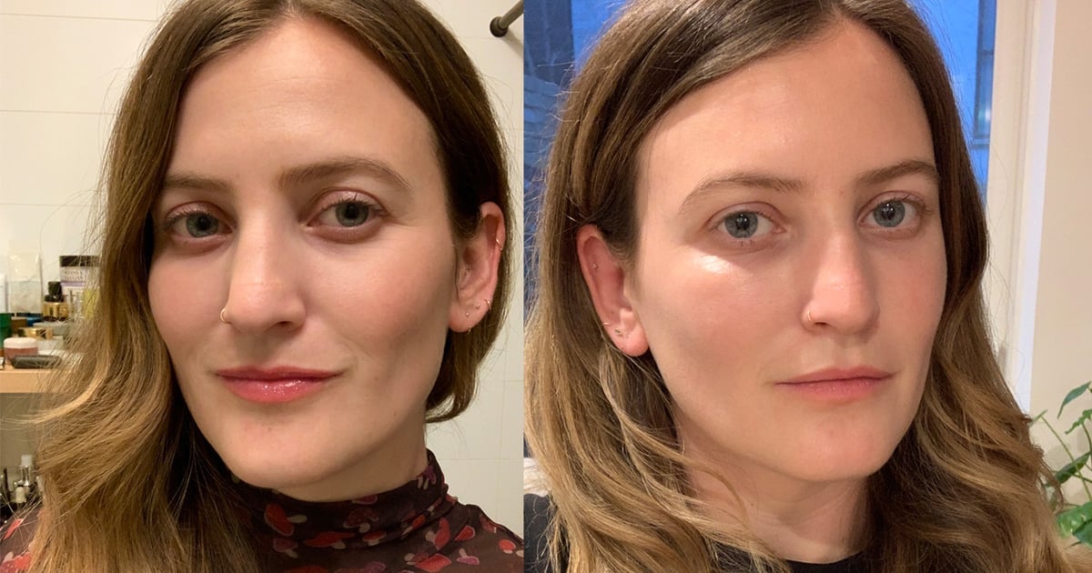 Filler Before After POPSUGAR Beauty