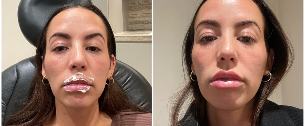 I Got My Lip Filler Dissolved: See Photos