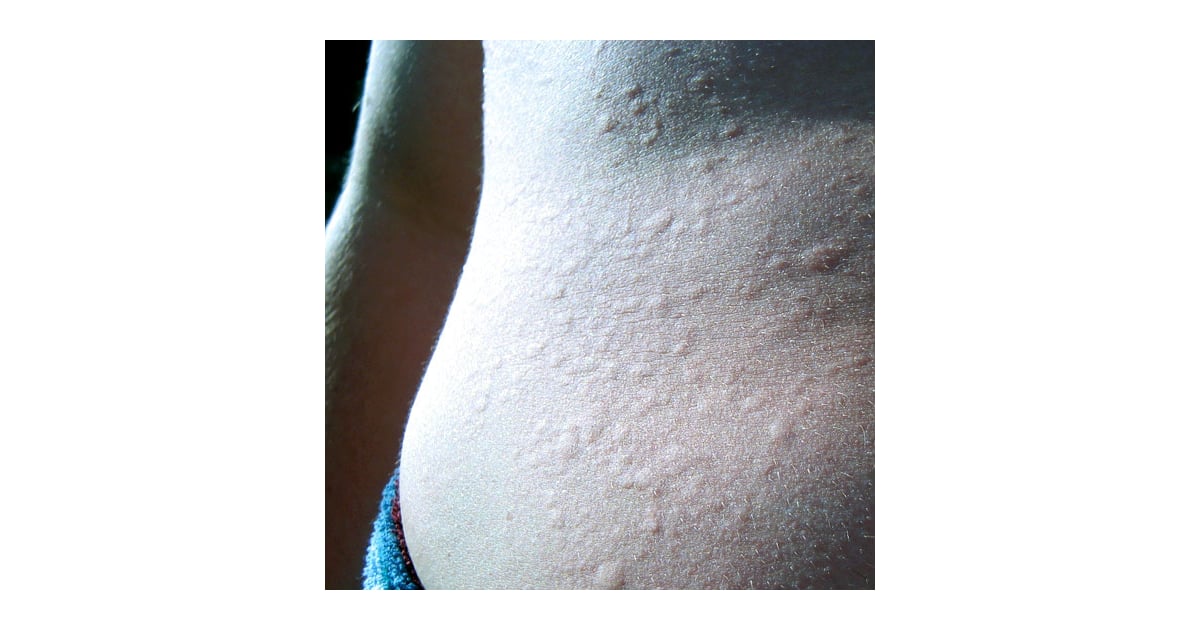 Swimming Gives You a Bad Case of Hives Weird Things That Happen to