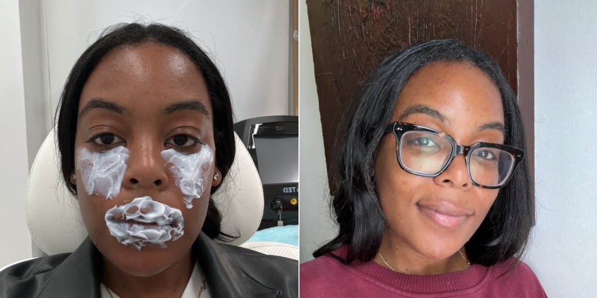 I Tried Restylane Eyelight Undereye Filler: Review, Photos - Vimarsana News
