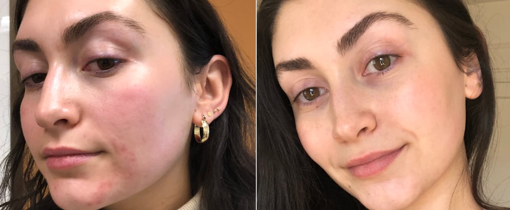What to Know About Laser Treatments for Red Acne Marks