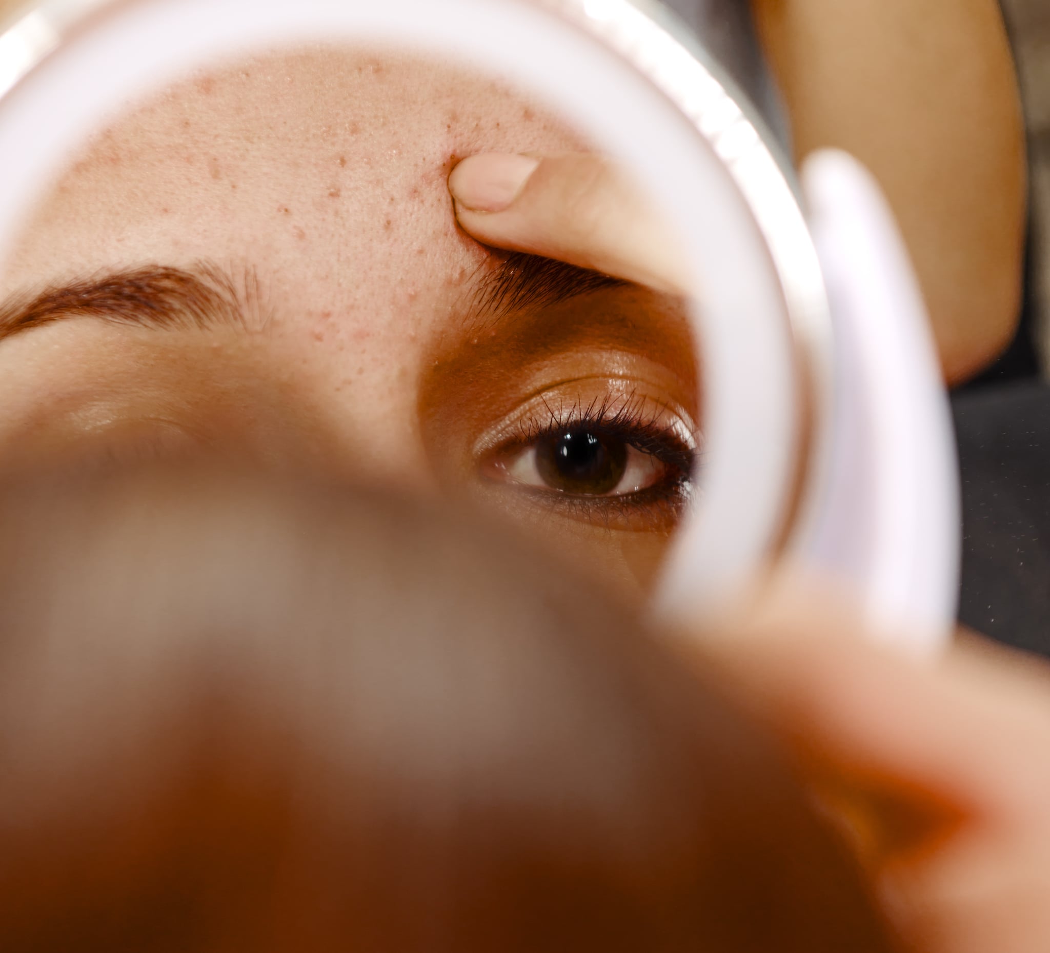 One woman shares her experience dating with acne 