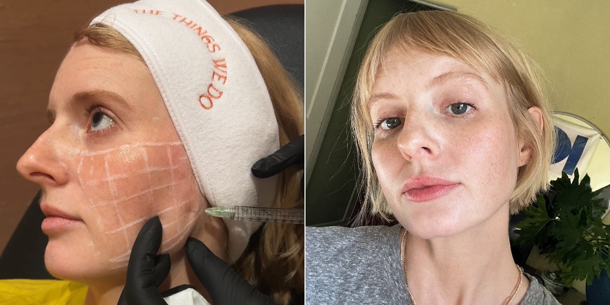 I Tried Skinvive, the Buzzy New "No-Filler" Filler