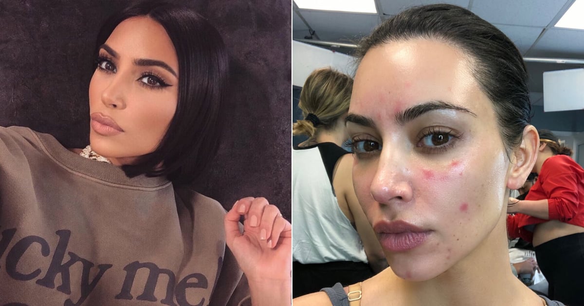 Is Kim Kardashian West's method of using body makeup on psoriasis safe?