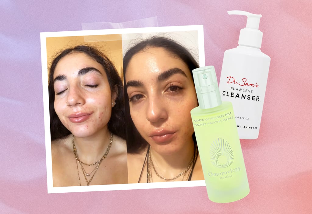 Keeping Acne Skin Hydrated on Accutane: An Expert Weighs In