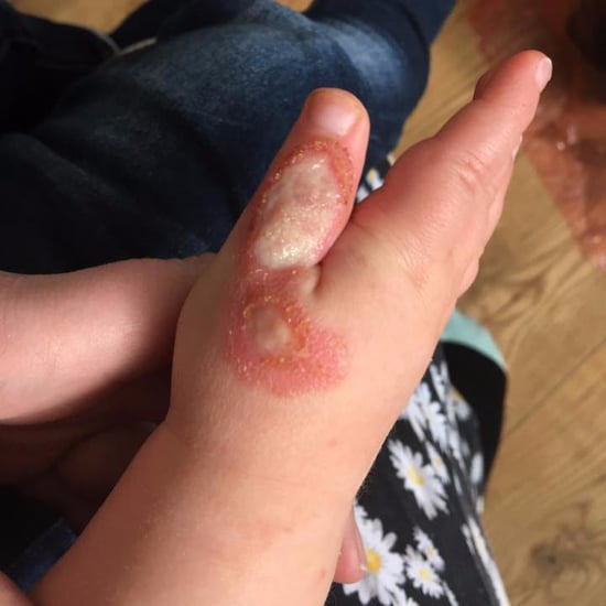 Vacuum Cleaner Burns Toddler