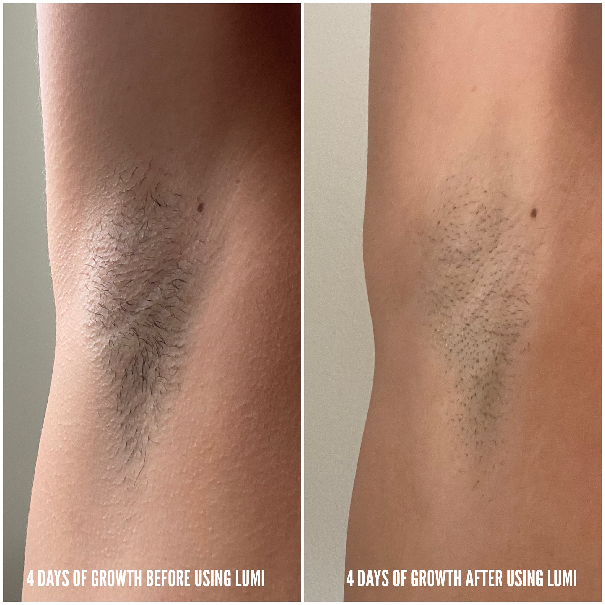 RoseSkinCo Lumi IPL Hair Removal Handset Review