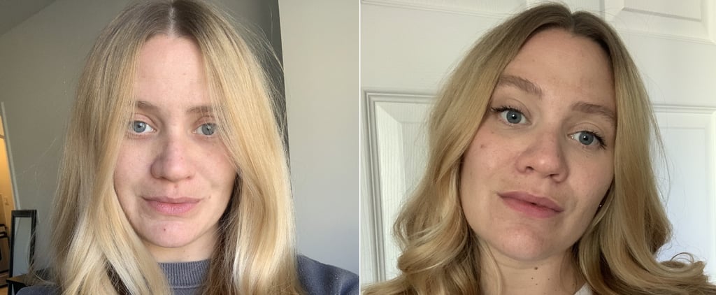 What No One Tells You About Acne During Pregnancy