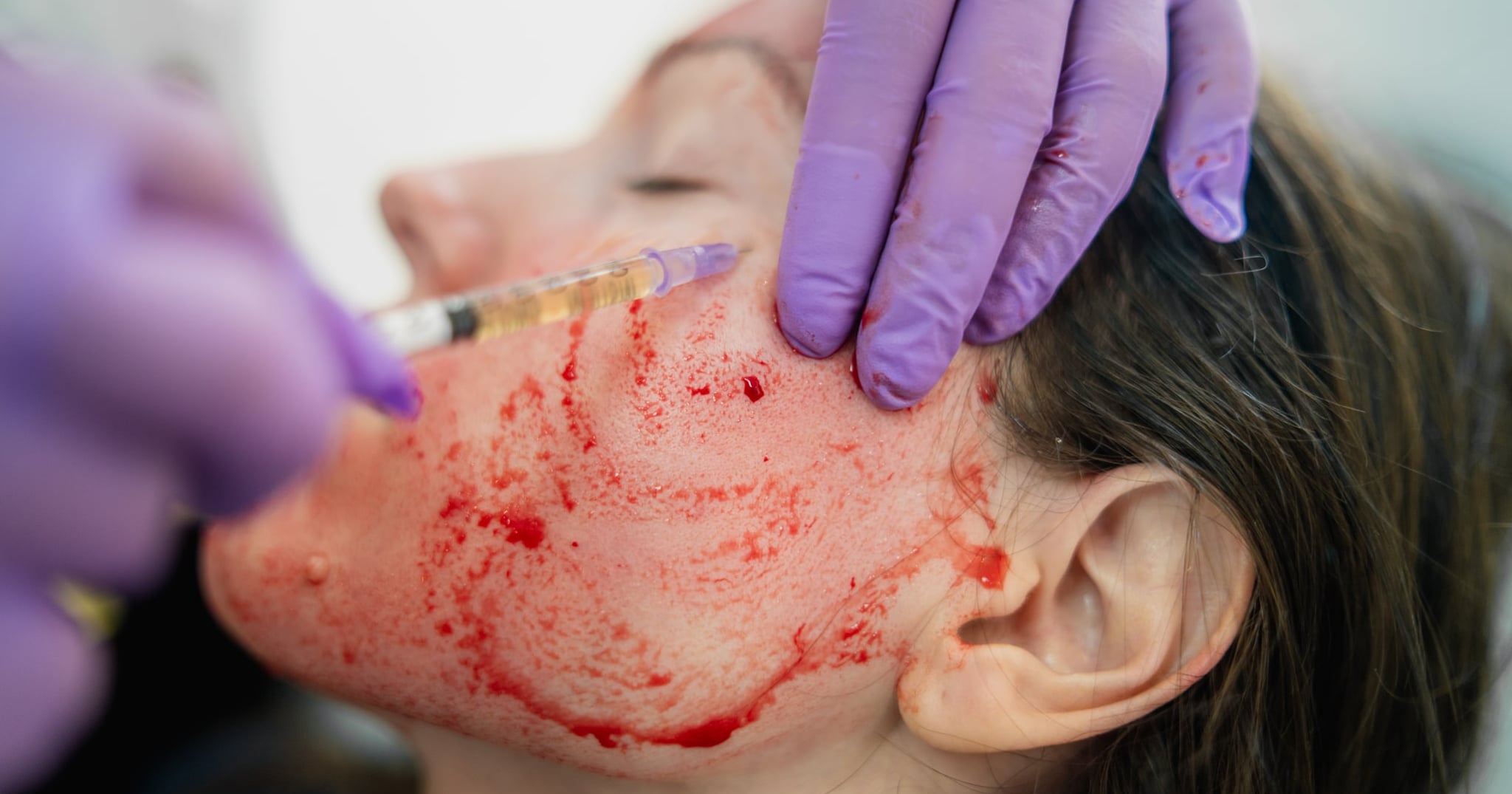 Multiple People Have Been Diagnosed With HIV After Getting a “Vampire Facial”
